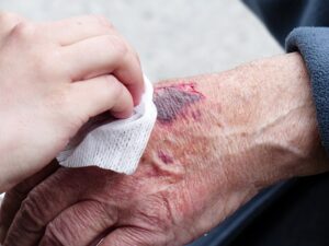 wound disinfection with electrolyzed water